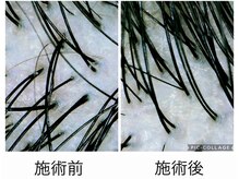 アンジール(ANJIR)/インディバ×ヘッドスパ