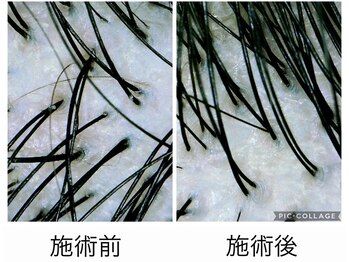 アンジール(ANJIR)/インディバ×ヘッドスパ