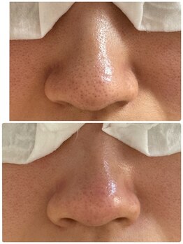 ロイジエ(Loyijie.w)/毛穴洗浄エステ