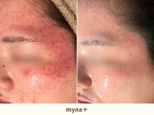 マイナプラ 表参道(myna+)/CHRISTINA/UNSTRESSピーリング