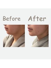 レポリア(Reporia)/キャビテーションBeforeAfter