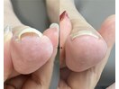 巻き爪&ネイルトリム&Nail trim