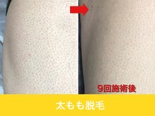 ミスターアンクール 鹿児島(Mr.uncoeur)/太もも脱毛9回後