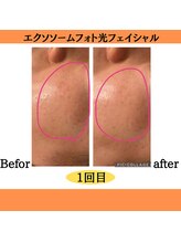 パルティノ 高崎店/エクソソーム光フェイシャル
