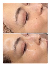 ホワイトアクア 甲府店(WHITEAQUA)/ララピール/毛穴/ニキビケア