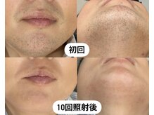 ケナシー(KENASY)の雰囲気（青髭解消！毎日の髭剃りが面倒な方はお試しください♪）