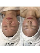 テンディ(TenD.)/マーメイドセルトリートメント