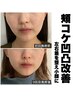 人気No.1【初回】小顔矯正＋リフトアップ機器施術＋筋膜リリース