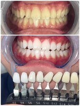 エクシアホワイトニング 札幌中島公園店/Before After［ホワイトニング］