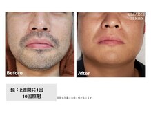 フィルムス(FILMS.)/ヒゲ脱毛のBeforeAfter