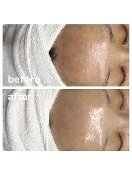 ミレボ 川内店(Me.rebo)/ララピール【 全顔+首 】