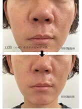 メディカルサロンドオフ 堺東店(medical salon de off)/LEZE(ルゼ)カクテルピーリング