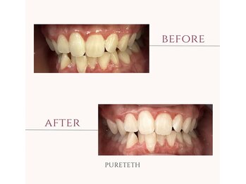 ピュアティス(PURETETH)/20代女性　before &after