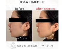 今までエステサロンで不可能だった根本改善で一度でも小顔◎