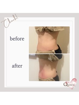 クイーン(QUEEN)/脂肪冷却