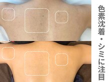 ピュアノア 三木店/背中ピーリング　三木|小野|西脇