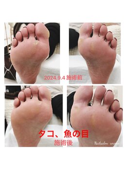 タコ、魚の目ケア