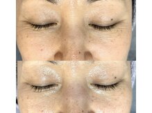 サロン ウルハ(Salon Uruha)/マイクロニードルピーリング！！