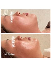 レ ベージュ(L’Beige)/美容溶解◆脂肪をすっきり小さく