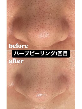 ホワイトアクア 福岡天神店(WHITE AQUA)/ハーブピーリングの1回での効果