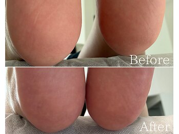 カシェット 広島店(Cachette)/40代女性☆足裏角質ケア60分