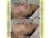 ハニエル(Haniel)/カーボキシー症例