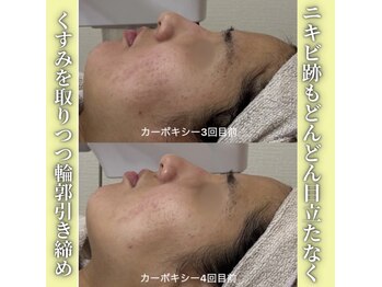 ハニエル(Haniel)/カーボキシー症例