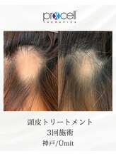 ユミト(Umit)/プロセルスカルプ