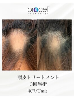 ユミト(Umit)/プロセルスカルプ