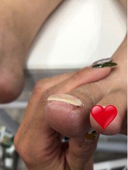 モア(More)/巻き爪矯正!