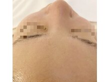 ゴールド 栄店(GOLD)/【2】ツルピカ美肌に○*゜