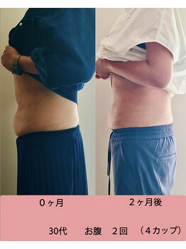 まつもと美容整体 整骨院/脂肪冷却効果!