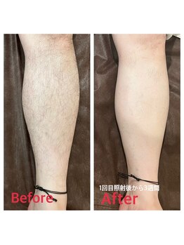 アンジェ(Ange)/脱毛１回目