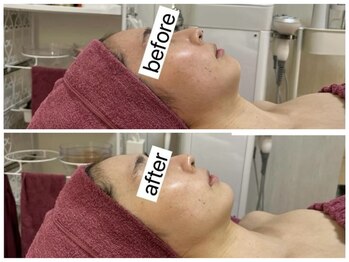 GRACETHOUSAND(グレイスサウザンド)/ハーブピーリング毛穴洗浄