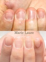 マリーロール 淀屋橋本店(Marie Laure)/自爪育成/深爪矯正/ネイルケア