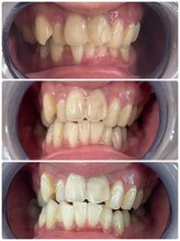 エクシアホワイトニング 札幌中島公園店/Before After［ホワイトニング］
