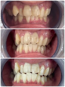 エクシアホワイトニング 札幌中島公園店/Before After［ホワイトニング］