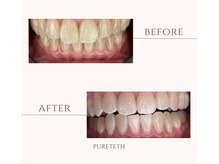 ピュアティス(PURETETH)/20代男性　before &after