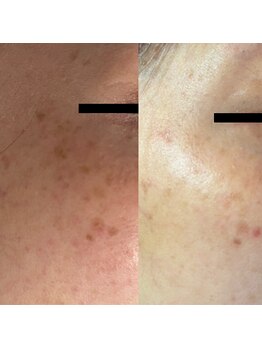 ドール(doll)/最先端シミケア、絆創膏いらず！