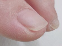 リル(relle)/巻き爪補正