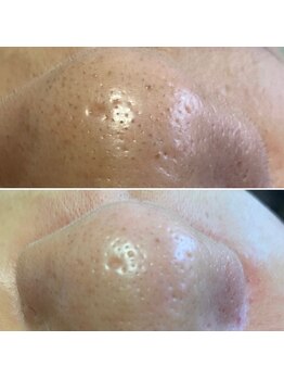 アルディート(Ardito)/毛穴スッキリ