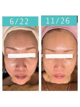 ココ 2号店(CoCo)/ホワイトスノーピール魅肌キープ