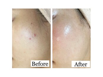 オリエンタルビューティー(ORIENTAL BEAUTY)/プラズマ×ラミネーションピール