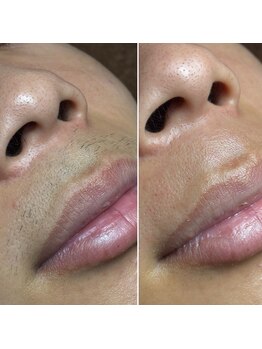 エピシアドットエヌ(epicia.N)/毎日の髭剃り無くしましょう!