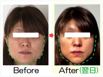 小顔矯正エステ プリュムレーヴ/30代｜エラ張りを整える