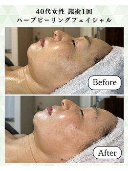 シーフェイス 横浜店(SEE FACE)/40代ハーブピーリングモニター