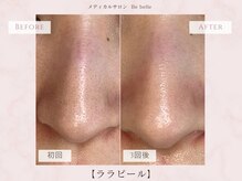 ビベル 八木店(Bebelle)/色素沈着毛穴の徹底改善