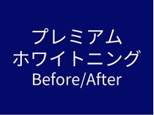 ホワイトニングカフェ 豊中店(WhiteningCafe)/◎ホワイトニングカフェ