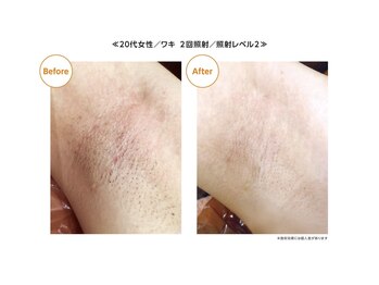 ファウラ(faura:)/ワキ脱毛