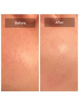 リュミエール デスポワール(Lumiere d'espoir)/毛穴洗浄＋ハーブピーリング